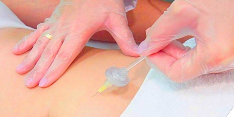 Carboxiterapia CO2 Carboxiterapia CO2